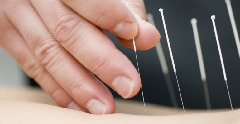 Chinese Acupuncture